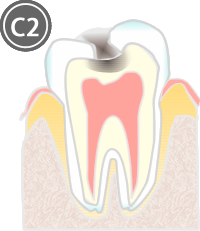 C2：象牙質に達した虫歯