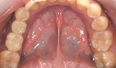 インプラント・臼歯の症例（20代・女性）