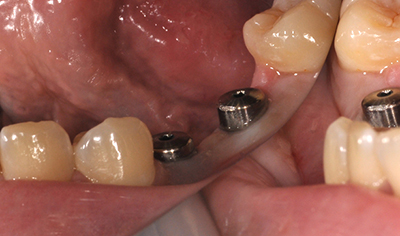 インプラント・臼歯の症例（20代・女性）