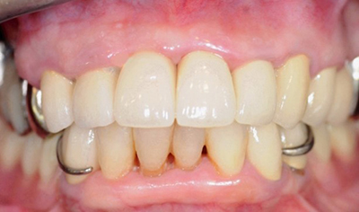 インプラント・前歯の症例（60代・女性）