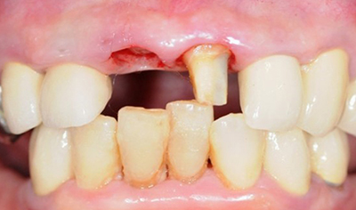 インプラント・前歯の症例（60代・女性）