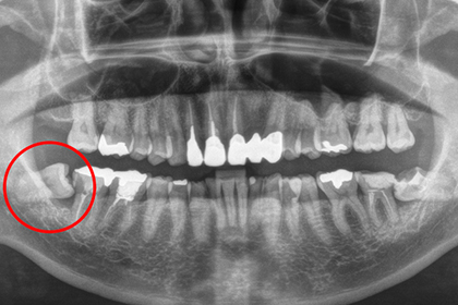 親知らずの抜歯
